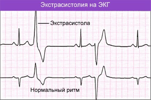 Холтеровское мониторирование экг что это такое — Сердце