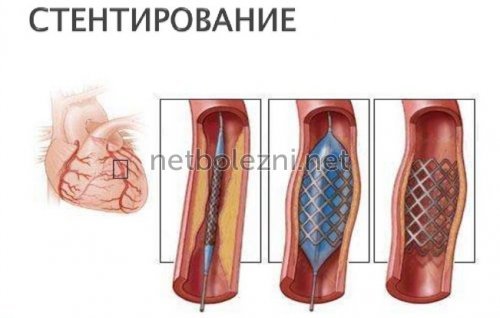 Стенд при инфаркте миокарда что это такое - Гипертонии нет
