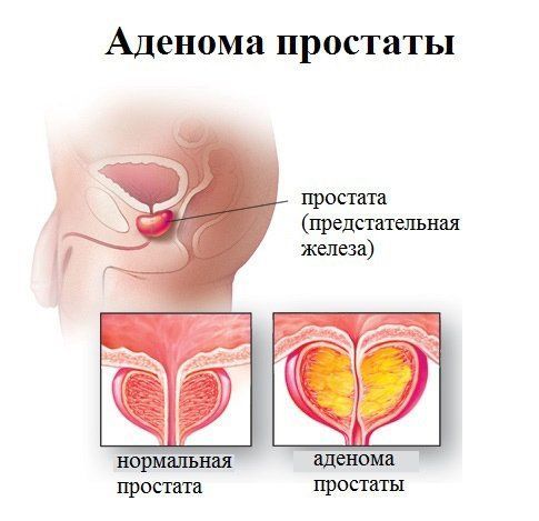 Спеман и его аналоги: Трибестан, Спематон, Спермактин и Спеман форте для мужчин