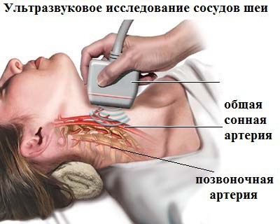 Асимметрия v4 сегментов позвоночных артерий d s. Можно ли вылечить синдром позвоночной артерии при остеохондрозе