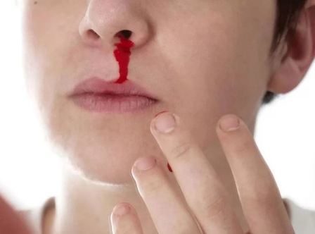 Первая помощь при кровотечении из носа: как правильно оказать медицинскую помощь (алгоритм) при сильном кровотечении, что нужно делать чтобы из носа пошла кровь без боли