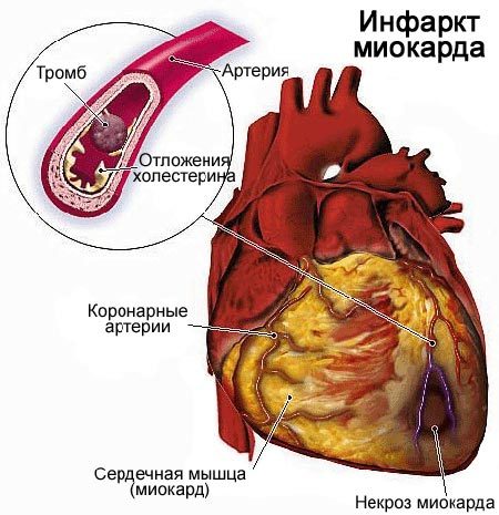 Инфаркт миокарда: симптомы и первая помощь