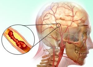Что такое ишемический инсульт: причины, формы, симптомы, лечение