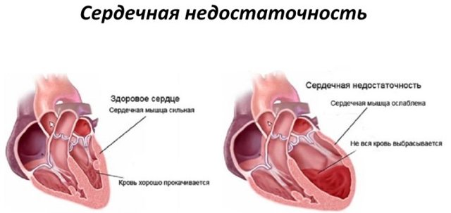 Анализ на СОЭ: норма и патологии. Что такое СОЭ и что показывает повышенная и пониженная скорость оседания эритроцитов?