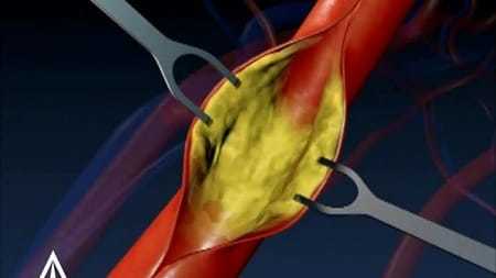 Тромб в сонной артерии: лечение, симптомы и удаление