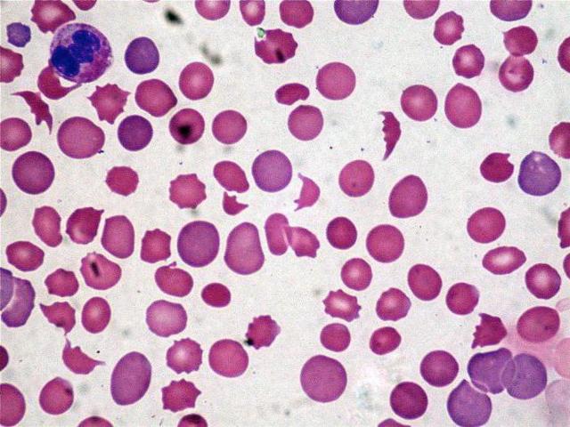 Повышенный билирубин – причины и симптомы билирубина, диагностика, лечение и профилактика