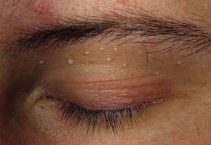 Повышенный холестерин в крови: что это значит, причины, лечение и симптомы у женщин и мужчин