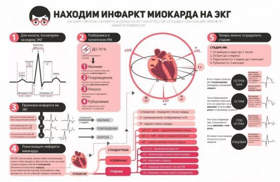 ЭКГ при инфаркте миокарда: фото пленок и расшифровка признаков