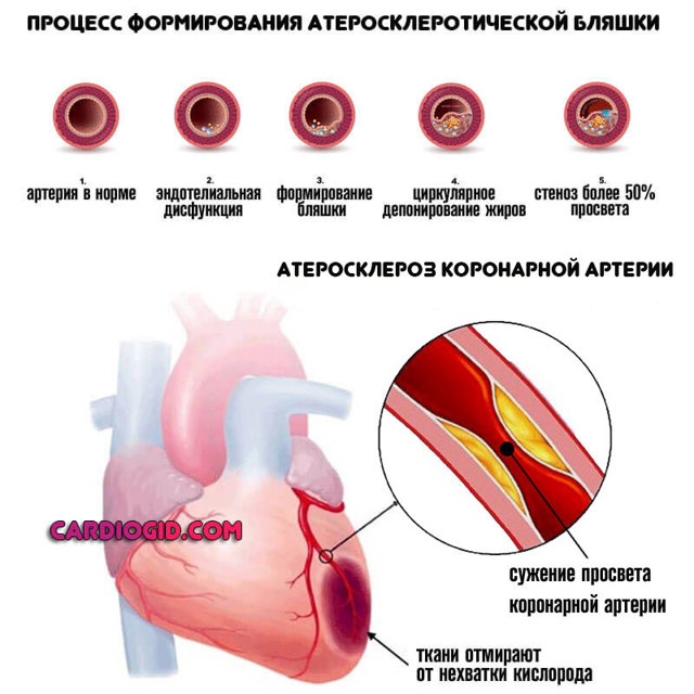 Стенокардия - что это такое, что делать при приступе