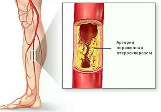 Болезни сосудов ног: причины появления и методы лечения