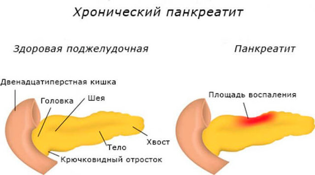 Тяжесть в желудке животе после еды: причины и лечение