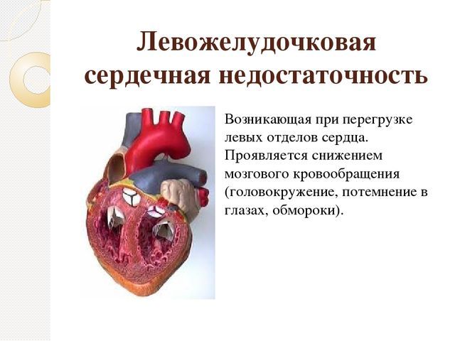 Левожелудочковая недостаточность: симптомы, лечение