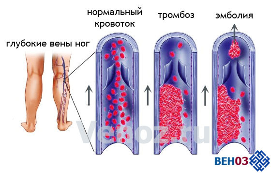 Лечение сосудов: как лечить болезни и заболевания сосудов и вен