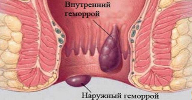 Лед при геморрое - можно прикладывать? •●Компрессы Примочки Ванночки●•