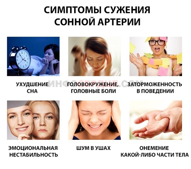 Атеросклеротические стенозы сонных артерий как причина мозгового инсульта - Сибирский медицинский портал