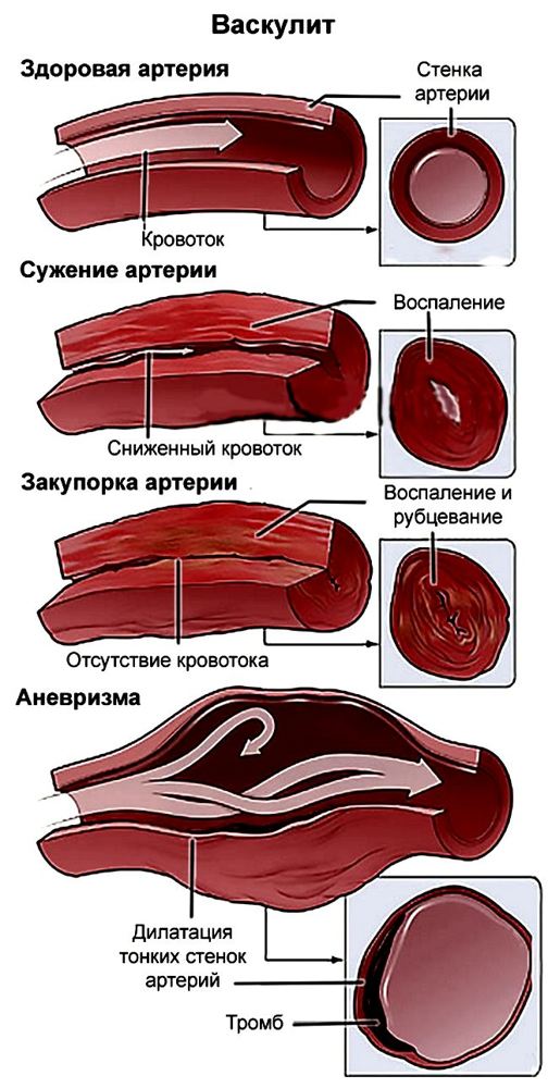 Васкулит мозга