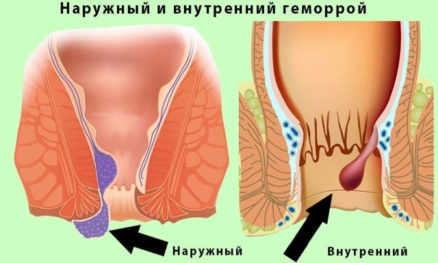 Геморрой - причины, симптомы, диагностика и лечение