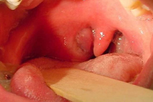 Паратонзиллярный абсцесс: лечение, фото, симптомы