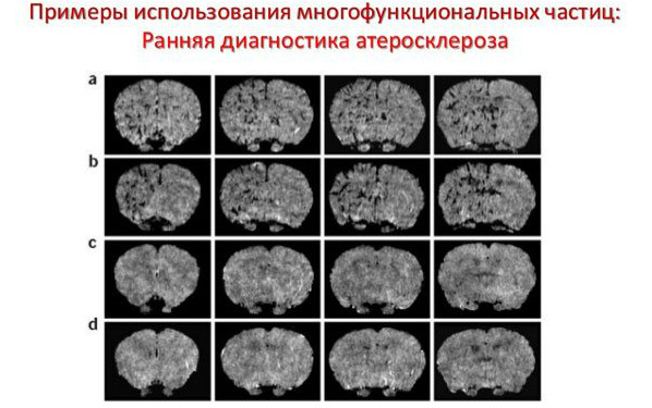 Диагностика атеросклероза