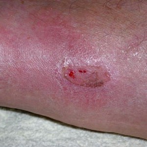 Варикозный дерматит нижних конечностей лечение народными средствами на сайте варикоз