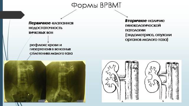 Варикоз вен малого таза у женщин: фото, симптомы и лечение