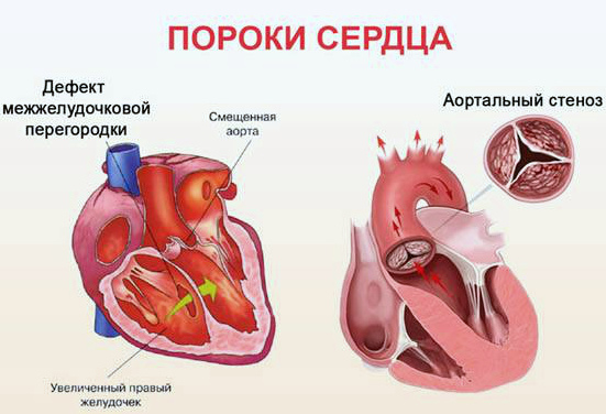 У ребенка 10-12 лет болит сердце - почему при дыхании возникает колющее или давящее чувство?