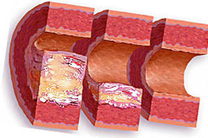 Уплотнение аорты – причины, симптомы, осложнения и лечение уплотнения аорты