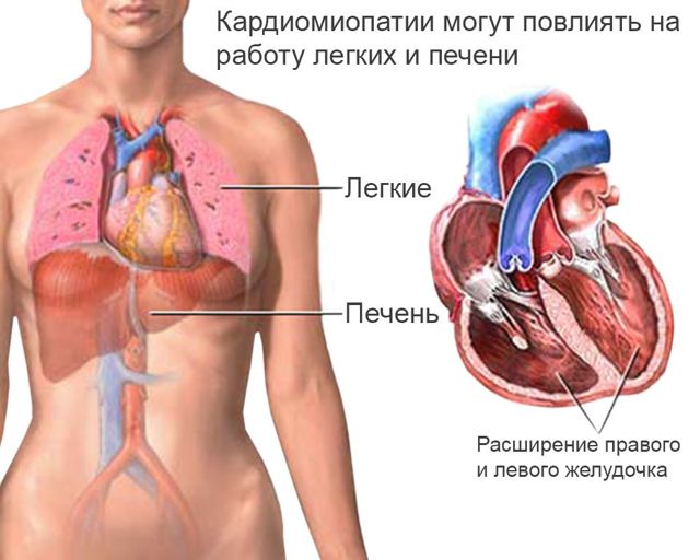 Дисметаболическая кардиомиопатия: симптомы и лечение