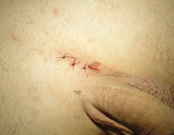 Видео операции варикоцеле яичка: процесс и исход