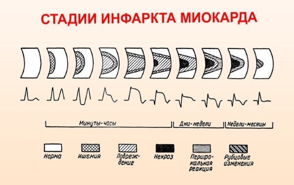 Обширный инфаркт сердца: что это такое, последствия, шансы выжить