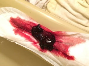 Месячные идут со сгустками крови и кусками — причины