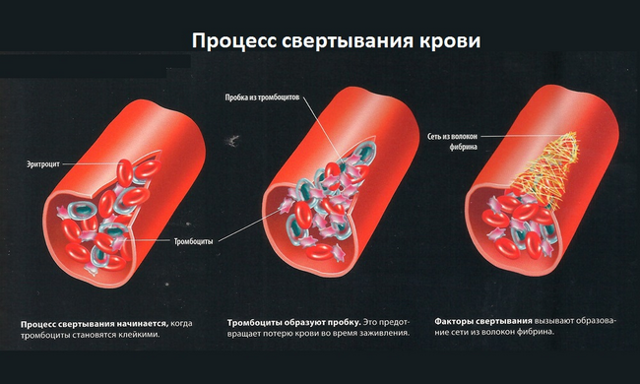 Повышенная свертываемость крови