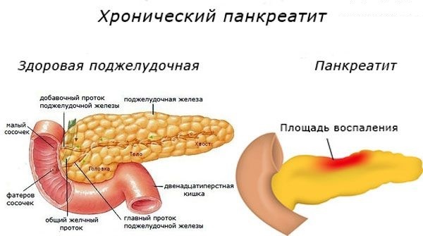 Альфа-амилаза в крови повышена