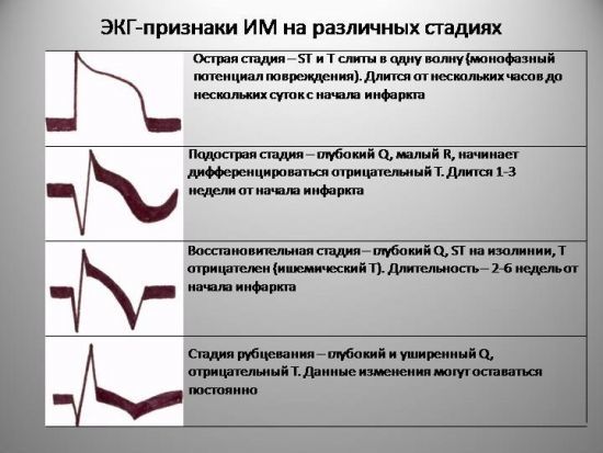 ЭКГ при инфаркте миокарда: фото пленок и расшифровка признаков