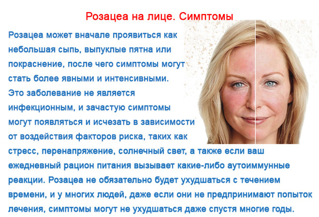 Розацеа на лице и теле: фото, симптомы, причины, лечение и видео