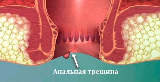 Зуд в заднем проходе у женщин: причины появления, лечение