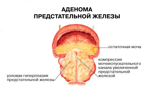 ПСА в крови. Что это значит и о чем оно говорит.