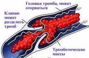 Почему оторвался тромб? Причины, симптомы и что делать?