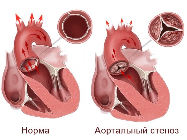 Аортальный стеноз лечение — Сердце