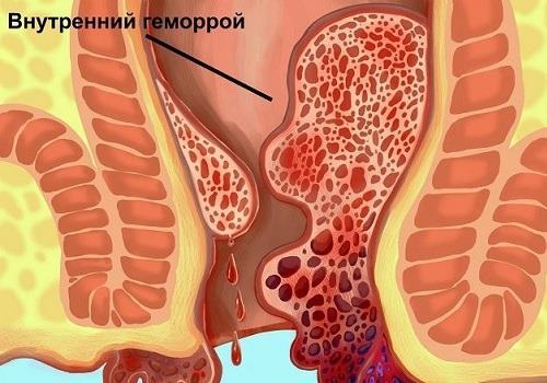 Криодеструкция геморроя - описание процедуры, отзывы