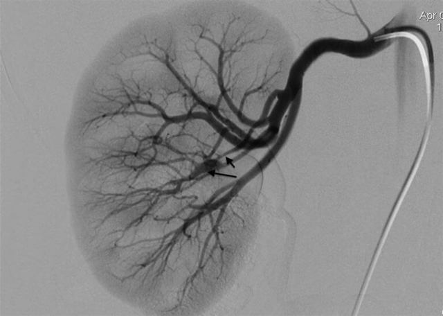 Реноваскулярная гипертензия - лечение, причины