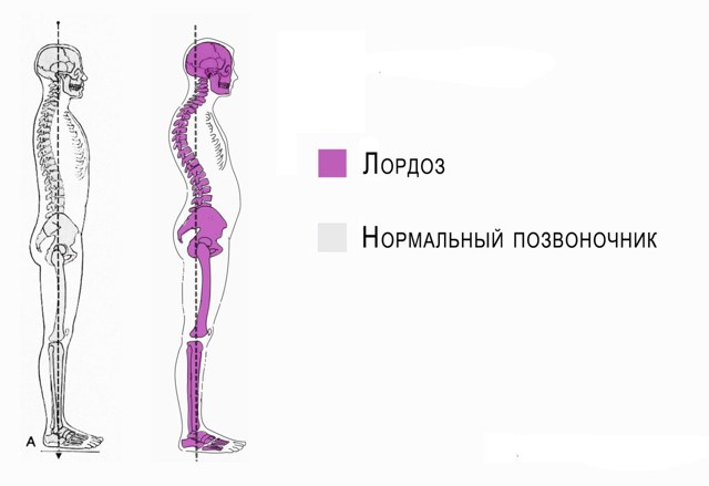 Лордоз – что это такое, как лечить и предупредить