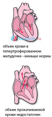 Систолическая жесткость сосудов и миокарда. Дисфункция предсердий и перегрузка объемом