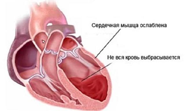 Кашель при сердечной недостаточности - Гипертонии нет