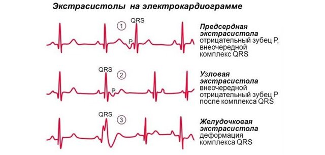 Экстрасистолия сердца: лечение, симптомы