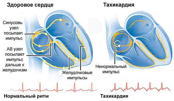 Тахикардия - причины, признаки, симптомы и лечение