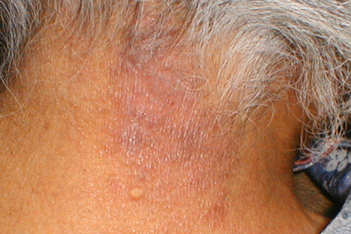 Нейродермит у взрослых и детей: симптомы (фото), лечение