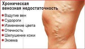 Венозная недостаточность симптомы признаки - Варикоз