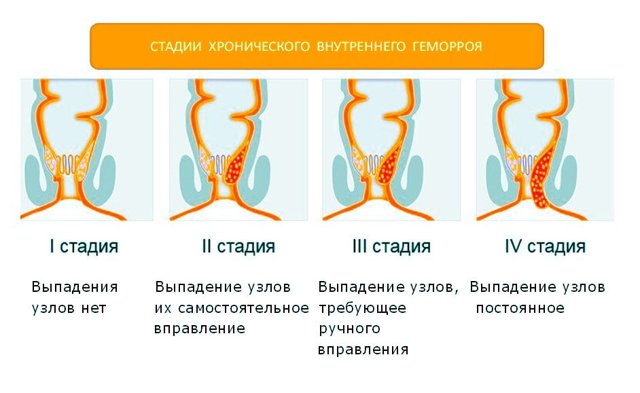 Троксевазин при геморрое: инструкция по применению