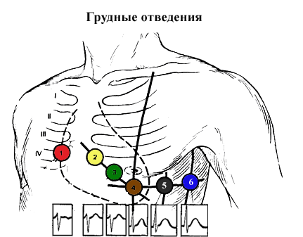Экг отведения по слопаку - Лечение гипертонии
